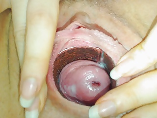 shy cervix